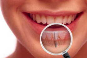 Dental Implants