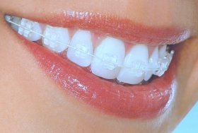 Orthodontics & Braces